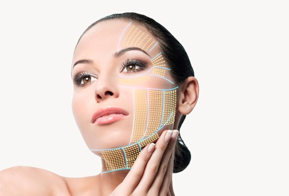 Woman’s face and neck with marked HIFU treatment zones for the jawline, cheek, brow and neck