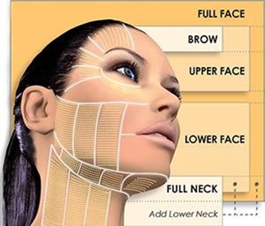 HIFU treatment zones illustrated on a woman's face and neck, with grid lines marking brow, upper face, lower face, full neck and lower neck areas