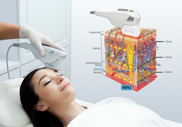 HIFU skin tightening Abu Dhabi treatment showing ultrasound focal depths in skin layers and SMAS