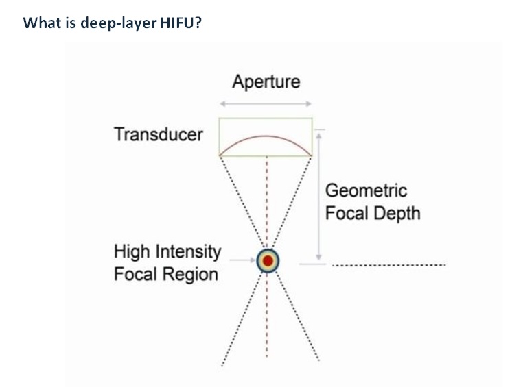 Diagram of a HIFU transducer focusing ultrasound energy to a high-intensity focal region at a set geometric focal depth