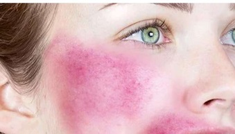 Red inflamed patch on the cheek after dermal filler treatment