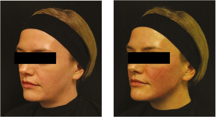 Before and after three-quarter view of a woman’s jawline contouring with mandibular angle and chin filler, historic case