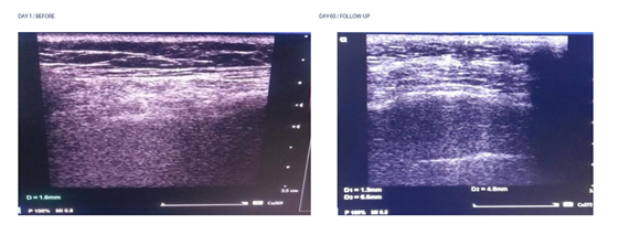 Additional facial ultrasound showing dermis and subcutaneous tissue after Endolift