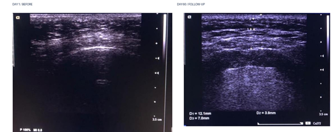 Facial ultrasound comparison of skin layers before and after 1470 nm laser