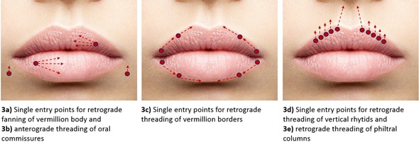 Three close-up lip images with arrows showing historical filler entry points for the vermilion body, borders, commissures and philtrum