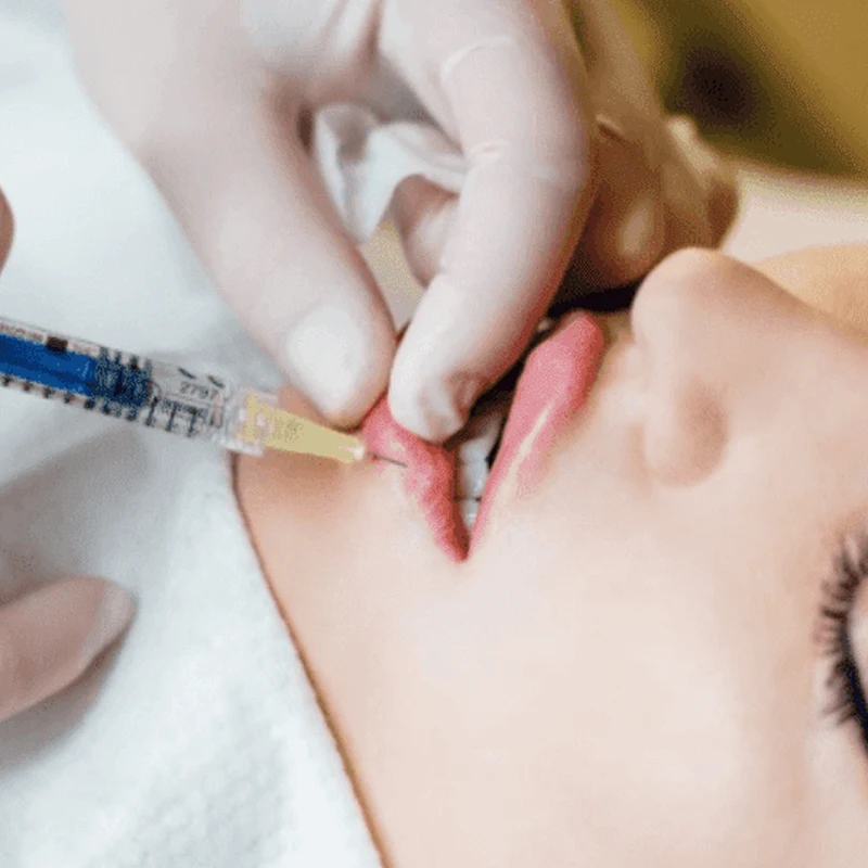 Clinician in gloves performing a hyaluronic acid lip filler injection on a patient’s upper lip