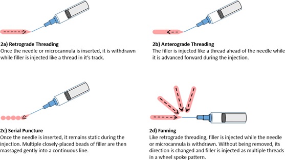 Diagram of four lip filler delivery patterns: retrograde threading, anterograde threading, serial puncture and fanning