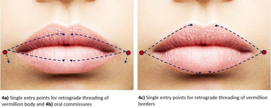 Two close-up lip images with arrows showing lateral microcannula entry points for the vermilion body, oral commissures and borders