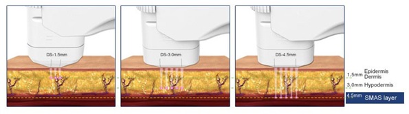 Diagram comparing 1.5 mm, 3.0 mm and 4.5 mm HIFU transducer focal depths in the skin and SMAS layer
