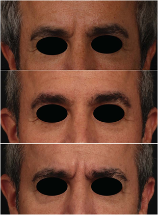 Male facial fillers in Abu Dhabi: three-quarter and frontal photos showing gradual, natural results across staged treatment