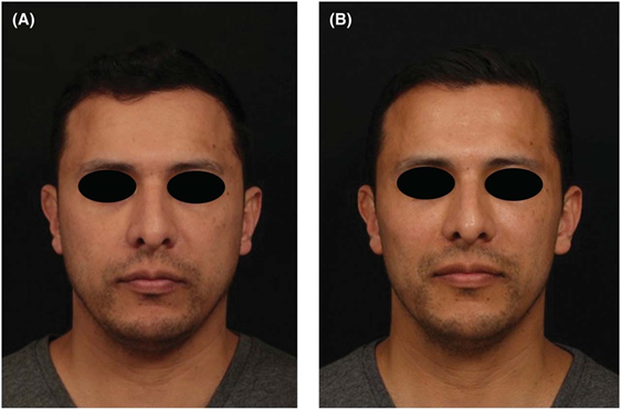 Before and after male facial fillers in Abu Dhabi, frontal view showing subtle natural contour improvement