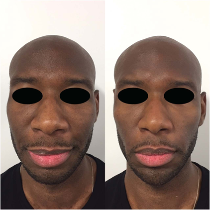 Male facial fillers in Abu Dhabi: frontal before and after view of combined cheek, chin and jawline contouring
