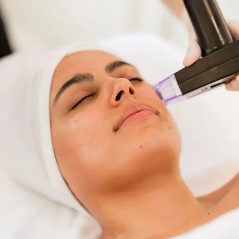 Morpheus8 RF microneedling treatment on the cheek and jawline in Abu Dhabi