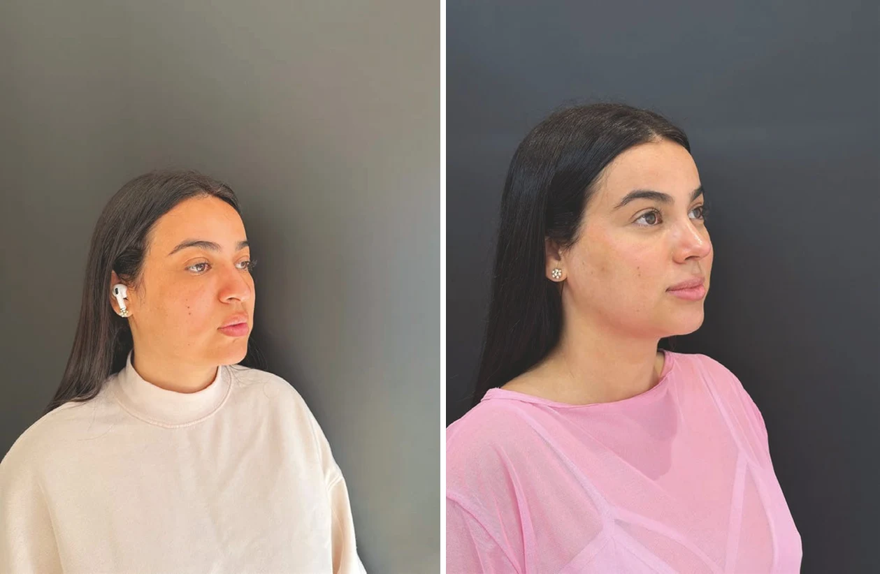 Before and after side-by-side profile photos of a female patient showing facial skin quality changes after low-energy Morpheus8 and nanofat treatment