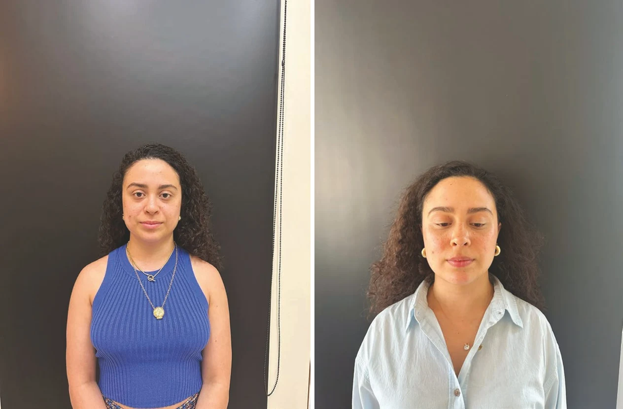 Before and after side-by-side front-view photos of a female patient showing facial skin quality changes after low-energy Morpheus8 and nanofat treatment