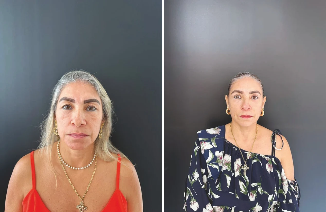 Before and after side-by-side front-view photos of a mature female patient showing facial skin quality changes after low-energy Morpheus8 and nanofat treatment