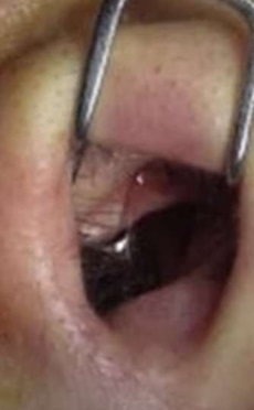 Internal view of nasal tissue injury