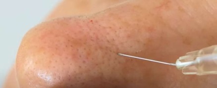 Needle injecting dermal filler into the nasal tip
