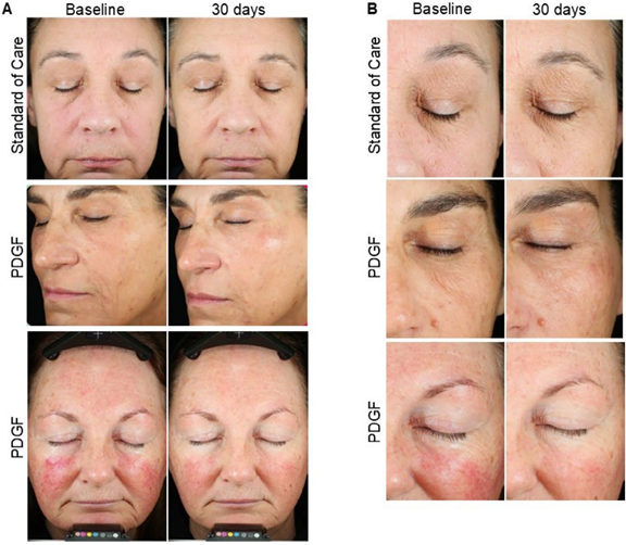 PDGF after RF microneedling: baseline vs day 30 photos compared with standard care