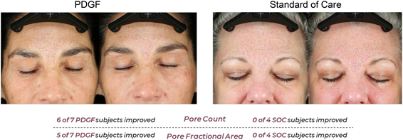 Pore count and pore area results: PDGF improved in 6 of 7 subjects vs 0 of 4 with standard care after RF microneedling