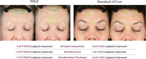 Wrinkle analysis at day 30: PDGF improved coarse area in 4 of 7 and mean thickness in 7 of 7 subjects vs standard care