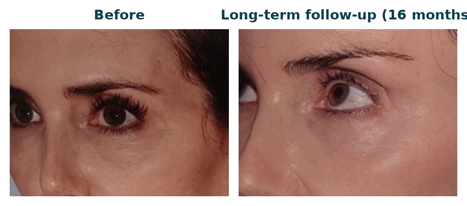 Morpheus8 Abu Dhabi periorbital rejuvenation: before and long-term follow-up photos of the eye area after a series of RF treatments