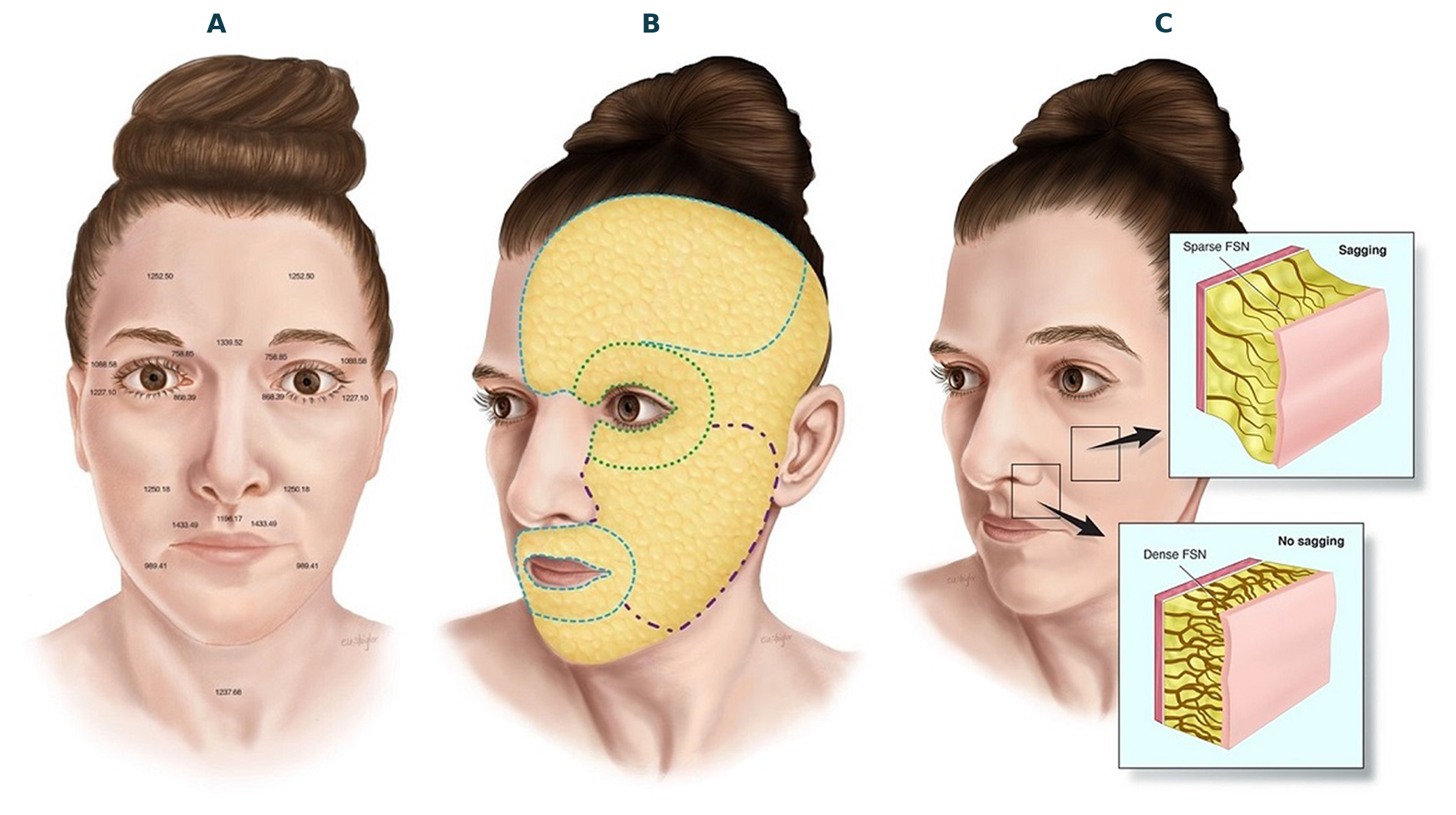Facial anatomy for Morpheus8 Abu Dhabi: dermal thickness, subcutaneous fat zones and fibroseptal network density that guide RF depth settings