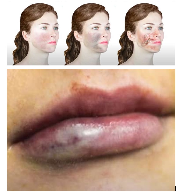 Progression of skin necrosis after filler and a swollen, discolored lip